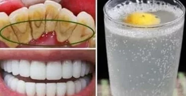 Se débarrasser de la plaque dentaire : 6 méthodes naturelles